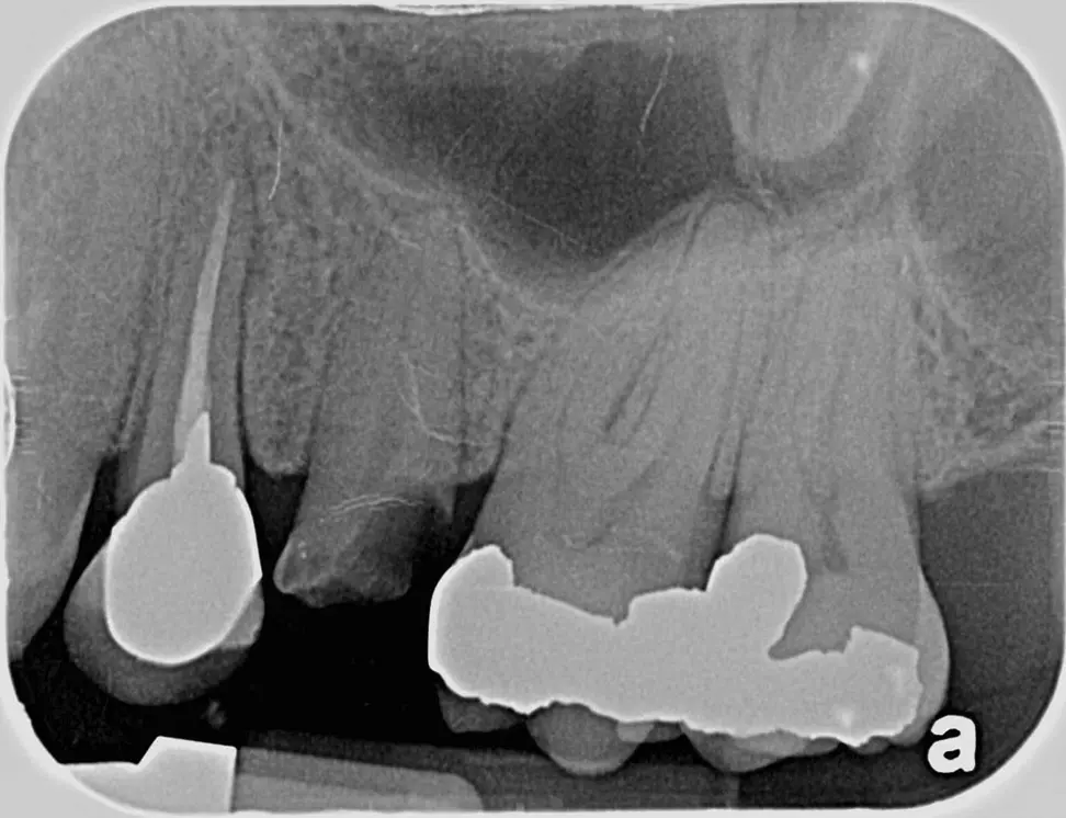 “Anybody can see that tooth needs to go”.  Image of a broken tooth (center).   The patient could easily see that this tooth has lost a great deal of structure and may not be restorable. 