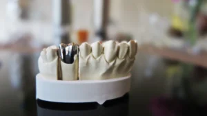 Close-up of a dental model showcasing a metal crown, highlighting same-day crowns by Family Dental Group.