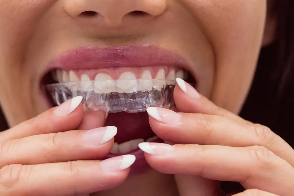 Close-up of a woman inserting ClearCorrect Aligners, highlighting her straight teeth, provided by Family Dental Group in Missoula, MT.