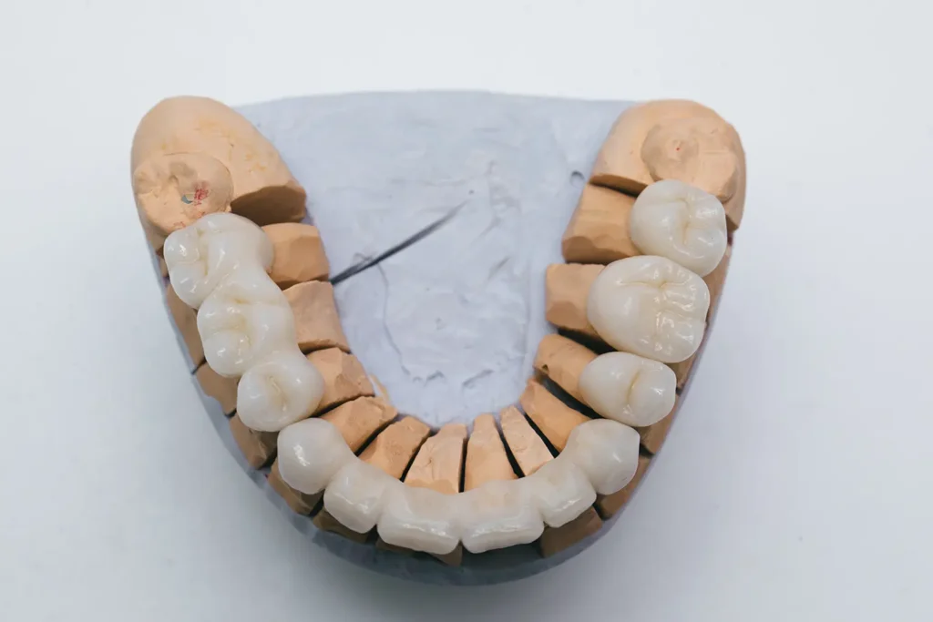 Model of dental crowns on a plaster mold, illustrating various types of dental crowns and emergency same-day crowns.