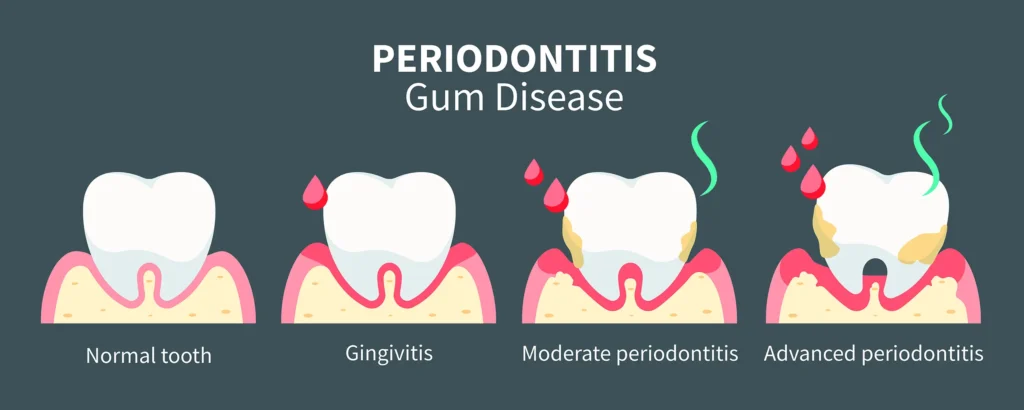 Illustration of the stages of gum disease from healthy gums to advanced periodontitis, highlighting the importance of oral health education by Family Dental Group.