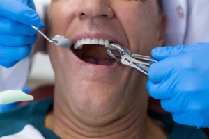 Dentist performing a tooth extraction procedure to improve oral health, with a focus on preventing further dental issues. Family Dental Group.