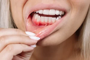 Close-up of a woman showing signs of gum disease with inflamed gums, emphasizing the importance of oral health, by Family Dental Group.