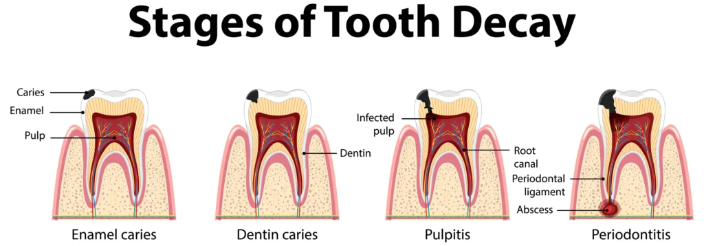 Illustration of the stages of tooth decay leading to potential tooth extraction to maintain oral health. Family Dental Group.